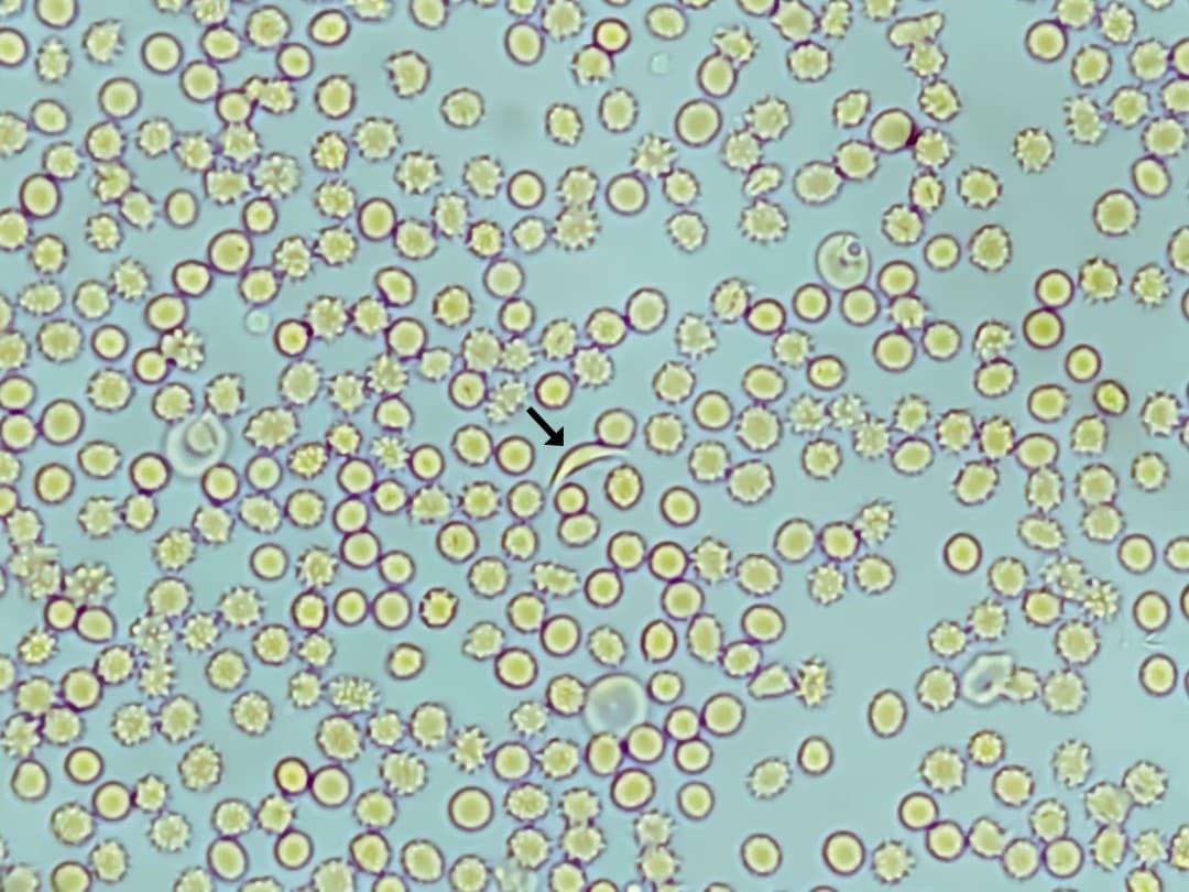 Louisiana patient becomes first in state to achieve functional cure for sickle cell disease