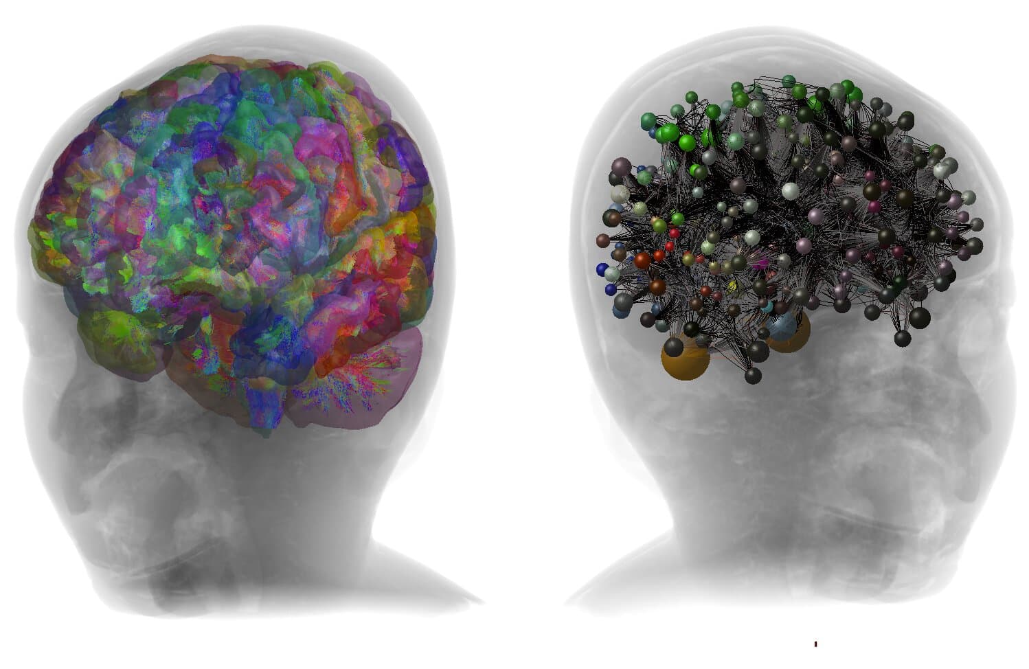 Digital brain model reveals neural signatures linked to autism in toddlers
