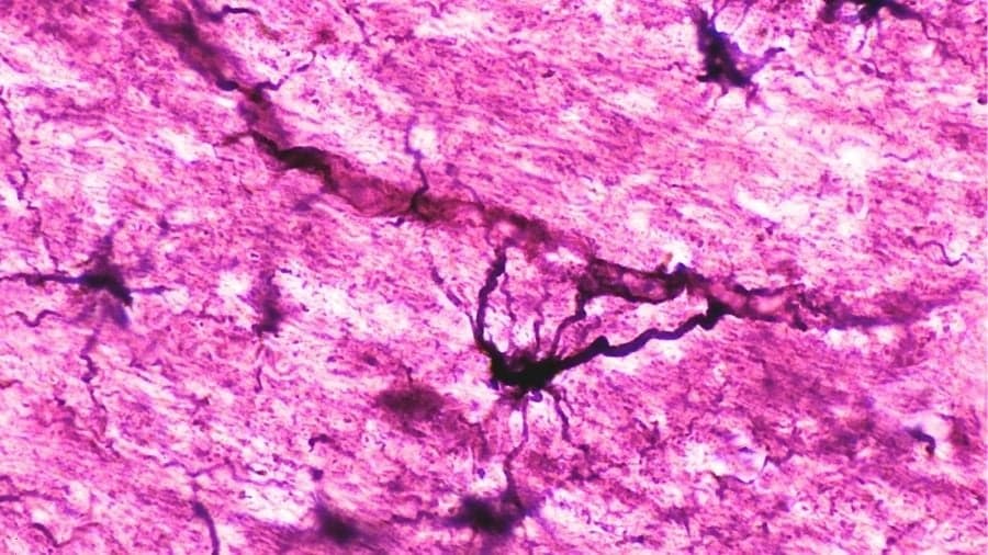 Two patients achieve remission from severe neuromyelitis optica via stem cell reset