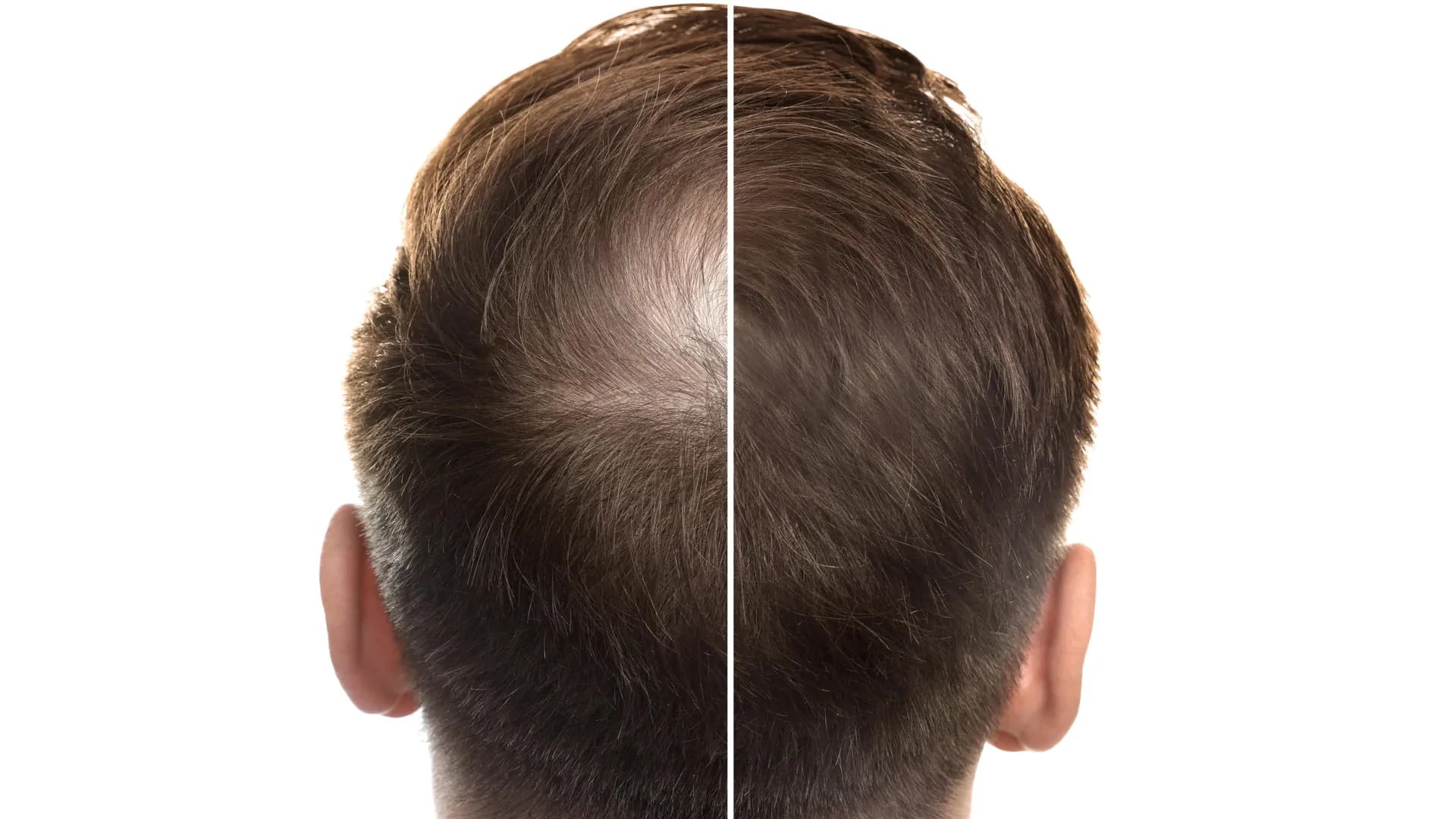 Traditional Chinese root shows promise against pattern hair loss in clinical studies